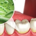 What are the types of oral hygiene?
