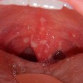 What are some examples of mouth diseases?