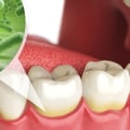 What is the cause of most oral disease?