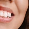 What is the most common oral disease?