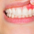What is the most serious mouth disease?