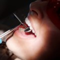 Dental Health Emergencies: Clear Aligners In Rockville, Maryland, Come To The Rescue
