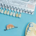 The Benefits Of Dental Crowns For Implants: Enhancing Dental Health In San Antonio, TX