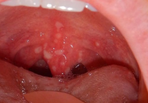 What are some examples of mouth diseases?