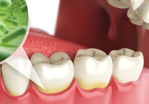 What is the cause of most oral disease?
