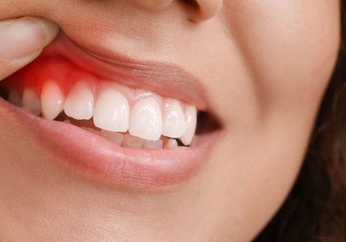What is the most common oral disease?