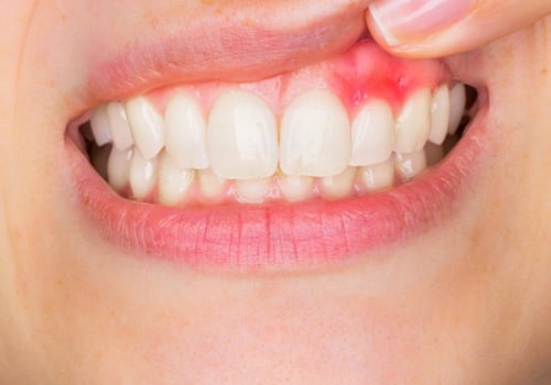 What is the most serious mouth disease?